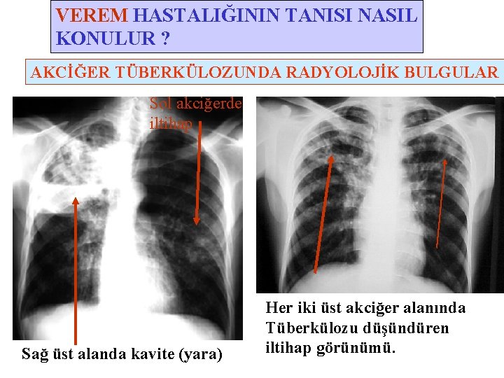 VEREM HASTALIĞININ TANISI NASIL KONULUR ? AKCİĞER TÜBERKÜLOZUNDA RADYOLOJİK BULGULAR Sol akciğerde iltihap Sağ