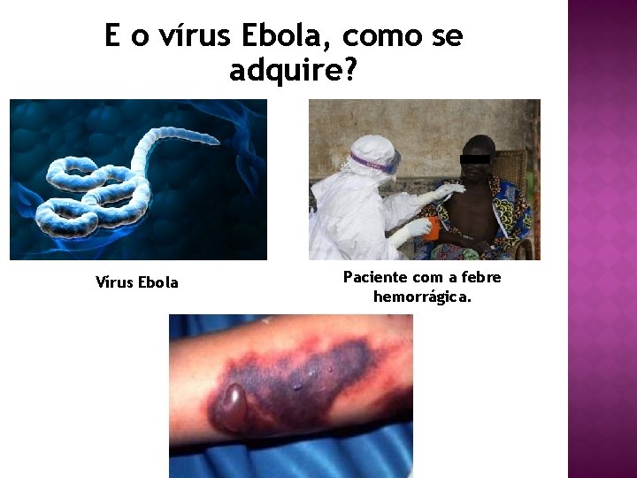 E o vírus Ebola, como se adquire? Vírus Ebola Paciente com a febre hemorrágica.