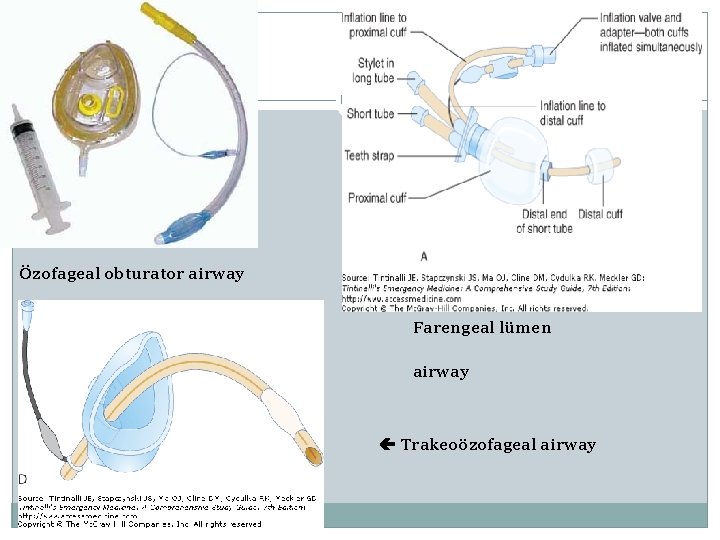 Özofageal obturator airway Farengeal lümen airway Trakeoözofageal airway 