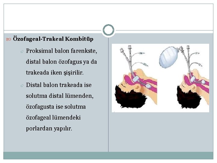  Özofageal-Trakeal Kombitüp Proksimal balon farenkste, distal balon özofagus ya da trakeada iken şişirilir.