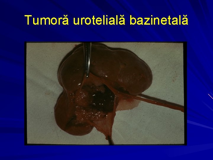 Tumoră urotelială bazinetală 