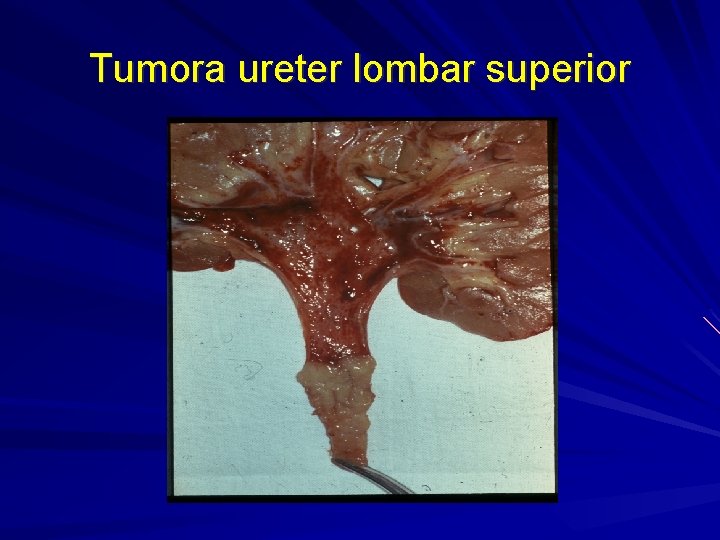 Tumora ureter lombar superior 