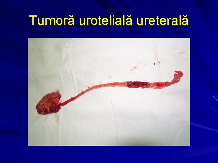 Tumoră urotelială ureterală 