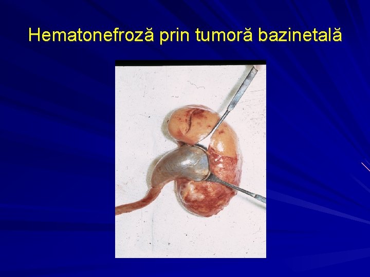 Hematonefroză prin tumoră bazinetală 