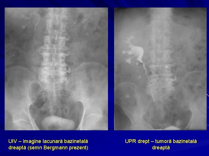 UIV – imagine lacunară bazinetală dreaptă (semn Bergmann prezent) UPR drept – tumoră bazinetală