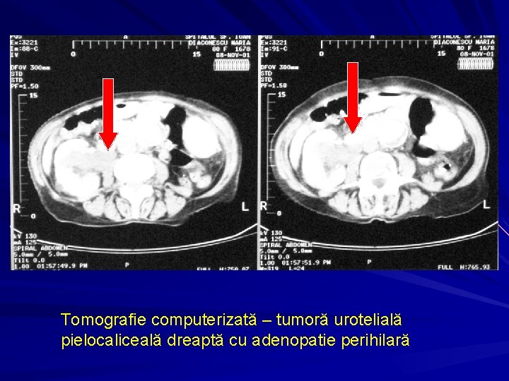 Tomografie computerizată – tumoră urotelială pielocaliceală dreaptă cu adenopatie perihilară 