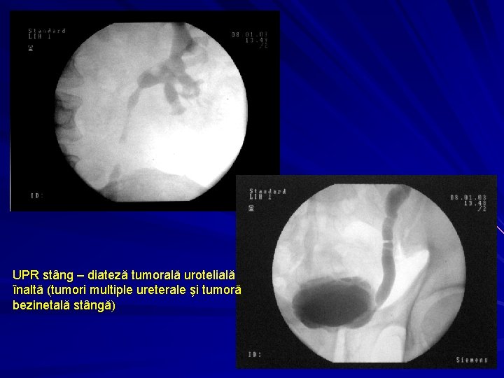 UPR stâng – diateză tumorală urotelială înaltă (tumori multiple ureterale şi tumoră bezinetală stângă)