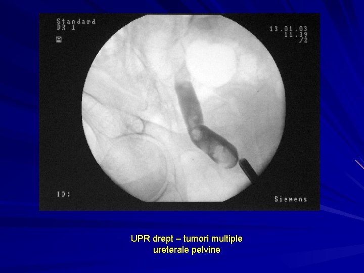 UPR drept – tumori multiple ureterale pelvine 