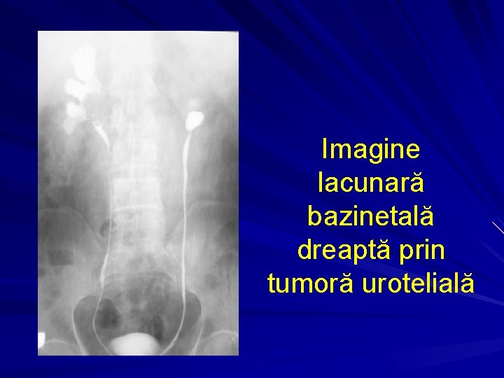 Imagine lacunară bazinetală dreaptă prin tumoră urotelială 