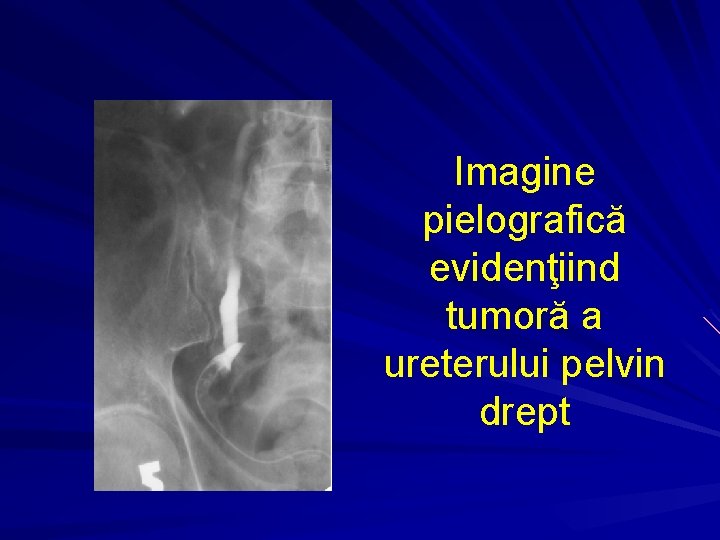 Imagine pielografică evidenţiind tumoră a ureterului pelvin drept 