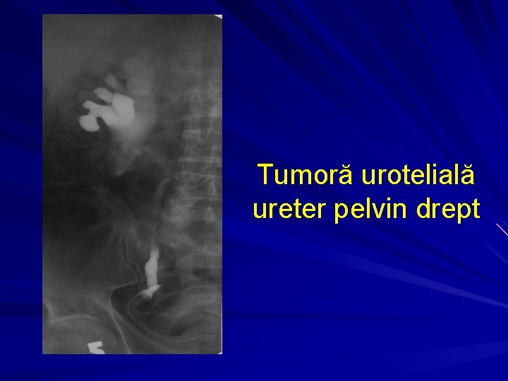 Tumoră urotelială ureter pelvin drept 