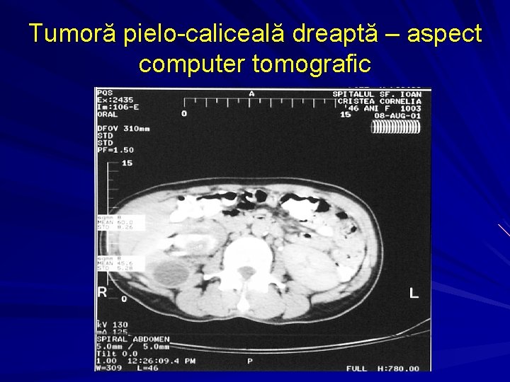 Tumoră pielo-caliceală dreaptă – aspect computer tomografic 