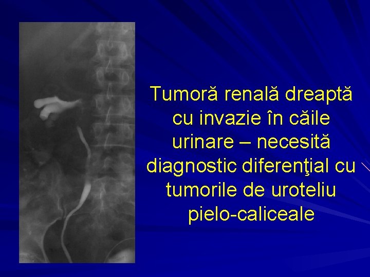 Tumoră renală dreaptă cu invazie în căile urinare – necesită diagnostic diferenţial cu tumorile