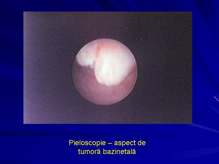Pieloscopie – aspect de tumoră bazinetală 