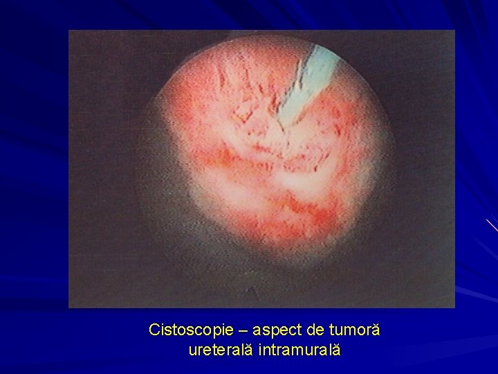 Cistoscopie – aspect de tumoră ureterală intramurală 