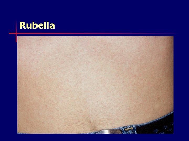 Rubella 