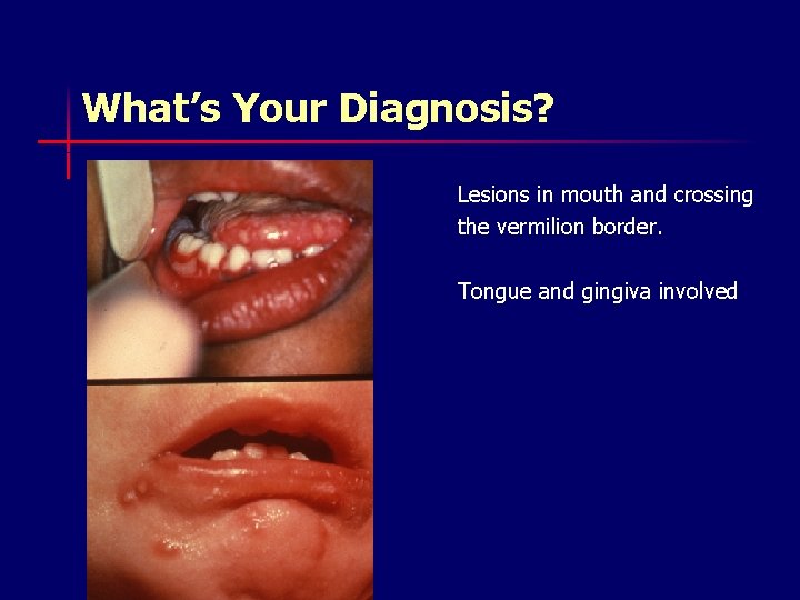 What’s Your Diagnosis? Lesions in mouth and crossing the vermilion border. Tongue and gingiva