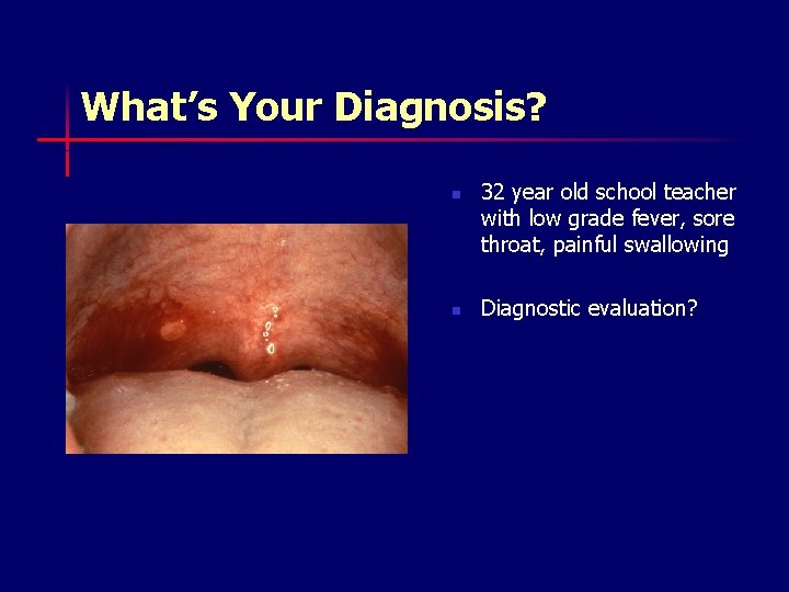 What’s Your Diagnosis? n n 32 year old school teacher with low grade fever,