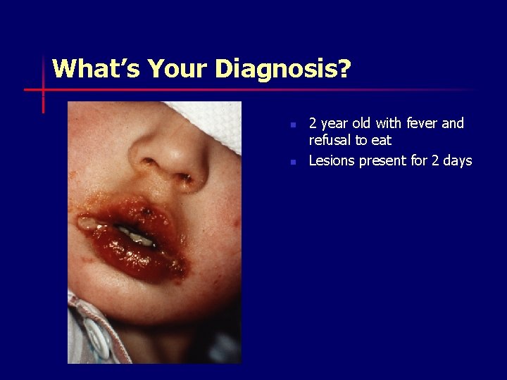 What’s Your Diagnosis? n n 2 year old with fever and refusal to eat