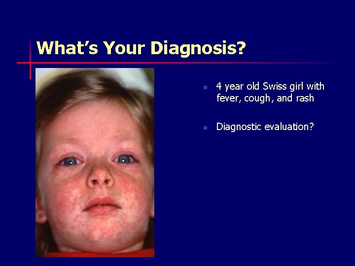 What’s Your Diagnosis? n n 4 year old Swiss girl with fever, cough, and