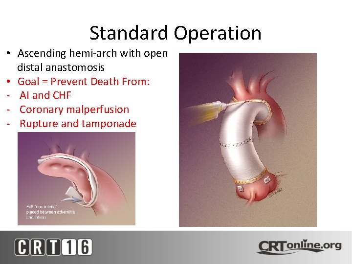 Standard Operation • Ascending hemi-arch with open distal anastomosis • Goal = Prevent Death