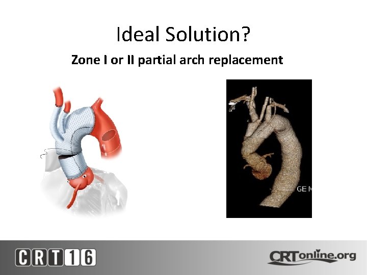 Ideal Solution? Zone I or II partial arch replacement 