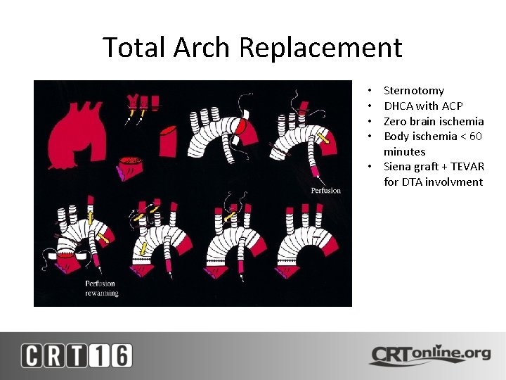 Total Arch Replacement Sternotomy DHCA with ACP Zero brain ischemia Body ischemia < 60