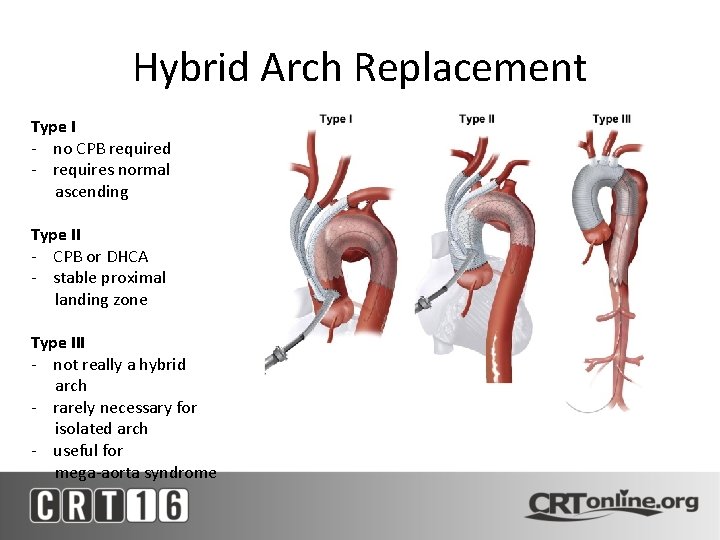 Hybrid Arch Replacement Type I - no CPB required - requires normal ascending Type