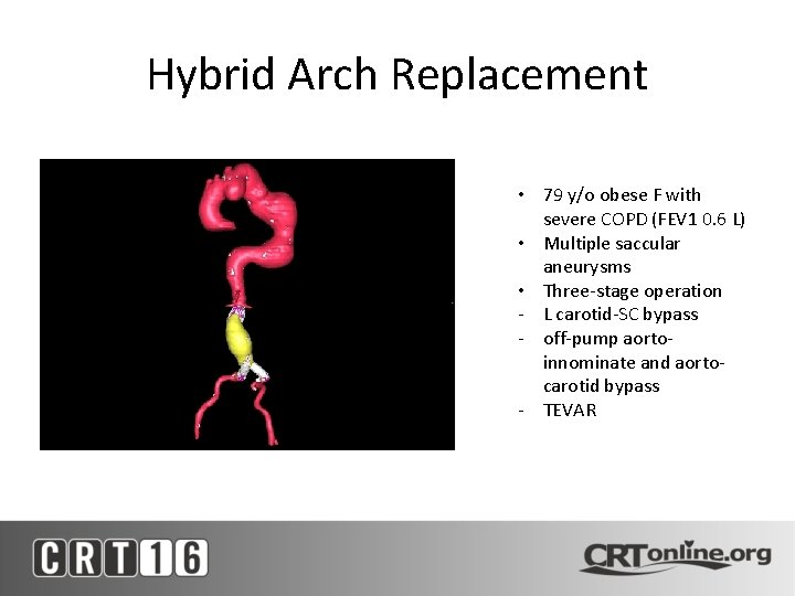 Hybrid Arch Replacement • 79 y/o obese F with severe COPD (FEV 1 0.