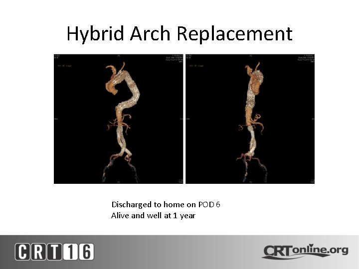 Hybrid Arch Replacement Discharged to home on POD 6 Alive and well at 1