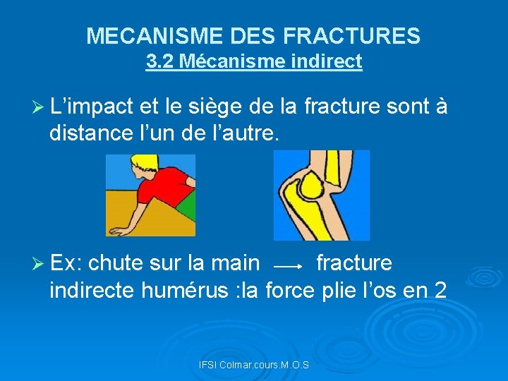 MECANISME DES FRACTURES 3. 2 Mécanisme indirect Ø L’impact et le siège de la