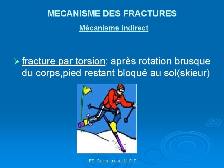 MECANISME DES FRACTURES Mécanisme indirect Ø fracture par torsion: après rotation brusque du corps,