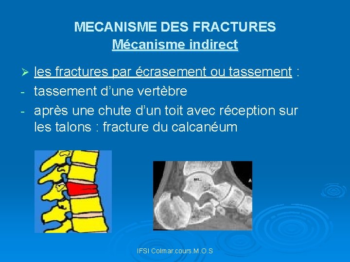 MECANISME DES FRACTURES Mécanisme indirect les fractures par écrasement ou tassement : - tassement