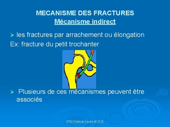 MECANISME DES FRACTURES Mécanisme indirect les fractures par arrachement ou élongation Ex: fracture du