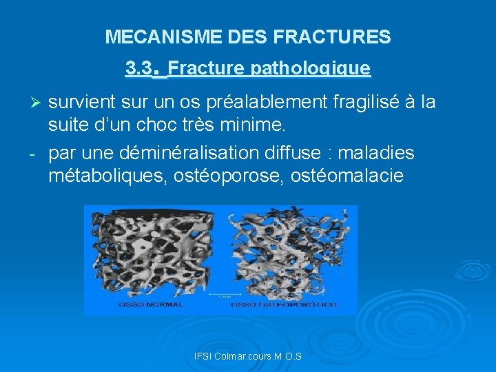 MECANISME DES FRACTURES 3. 3. Fracture pathologique survient sur un os préalablement fragilisé à