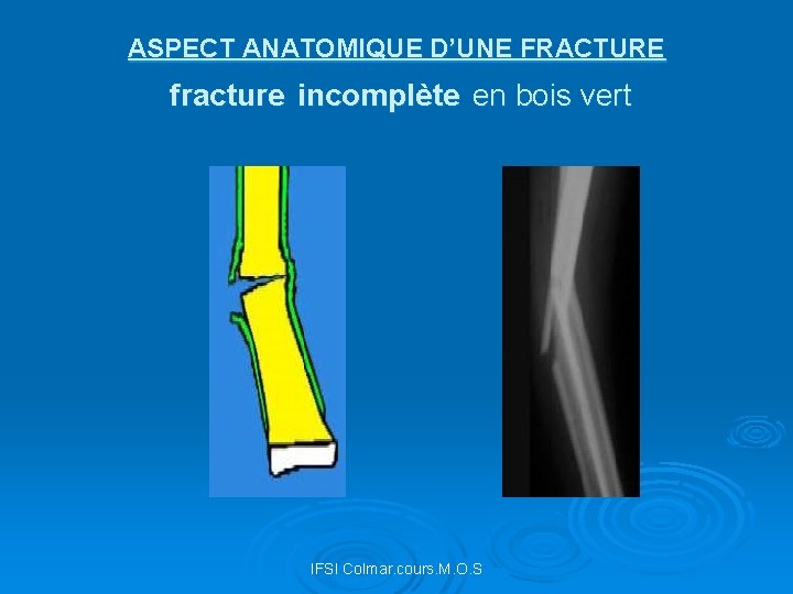 ASPECT ANATOMIQUE D’UNE FRACTURE fracture incomplète en bois vert IFSI Colmar. cours. M. O.