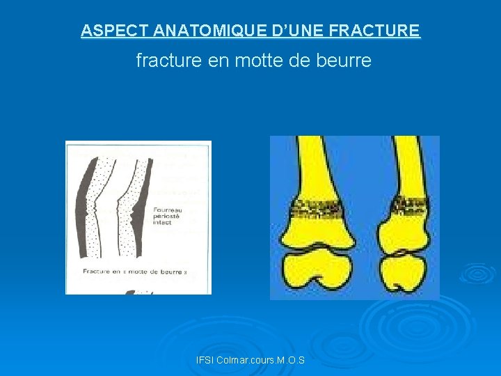 ASPECT ANATOMIQUE D’UNE FRACTURE fracture en motte de beurre IFSI Colmar. cours. M. O.