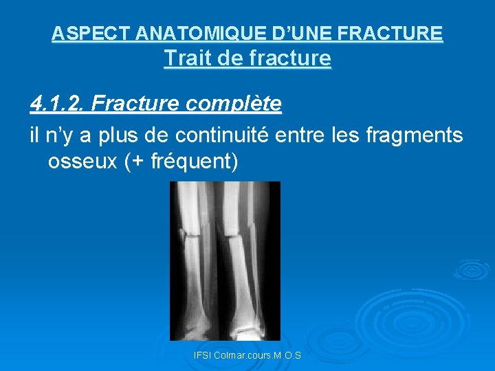 ASPECT ANATOMIQUE D’UNE FRACTURE Trait de fracture 4. 1. 2. Fracture complète il n’y