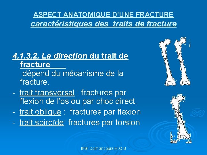 ASPECT ANATOMIQUE D’UNE FRACTURE caractéristiques des traits de fracture 4. 1. 3. 2. La