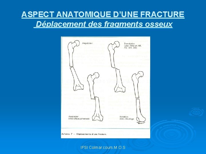 ASPECT ANATOMIQUE D’UNE FRACTURE Déplacement des fragments osseux IFSI Colmar. cours. M. O. S