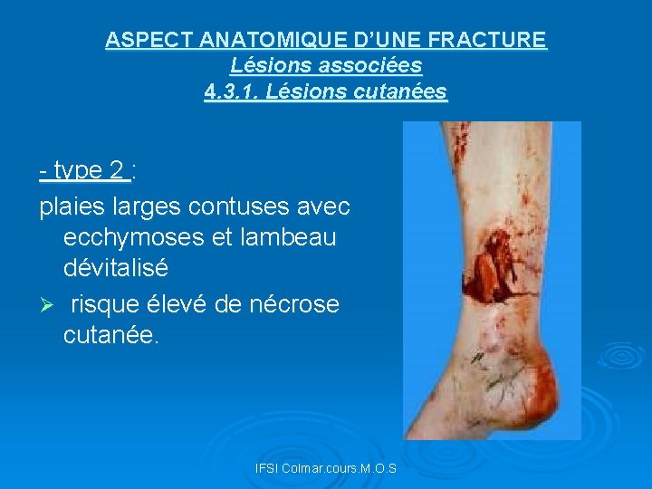 ASPECT ANATOMIQUE D’UNE FRACTURE Lésions associées 4. 3. 1. Lésions cutanées - type 2