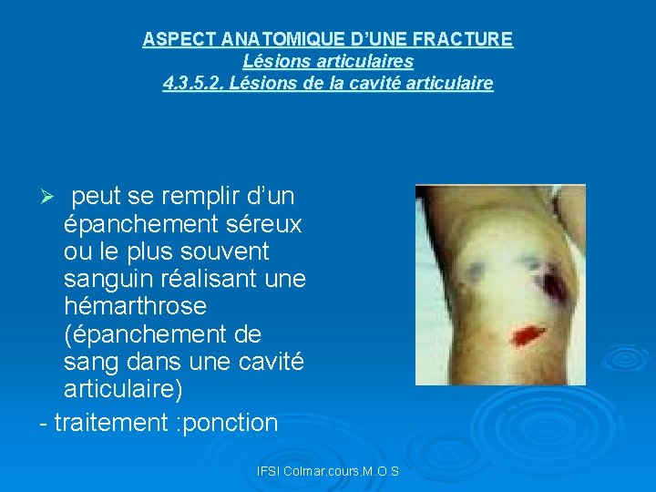 ASPECT ANATOMIQUE D’UNE FRACTURE Lésions articulaires 4. 3. 5. 2. Lésions de la cavité