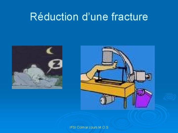 Réduction d’une fracture IFSI Colmar. cours. M. O. S 