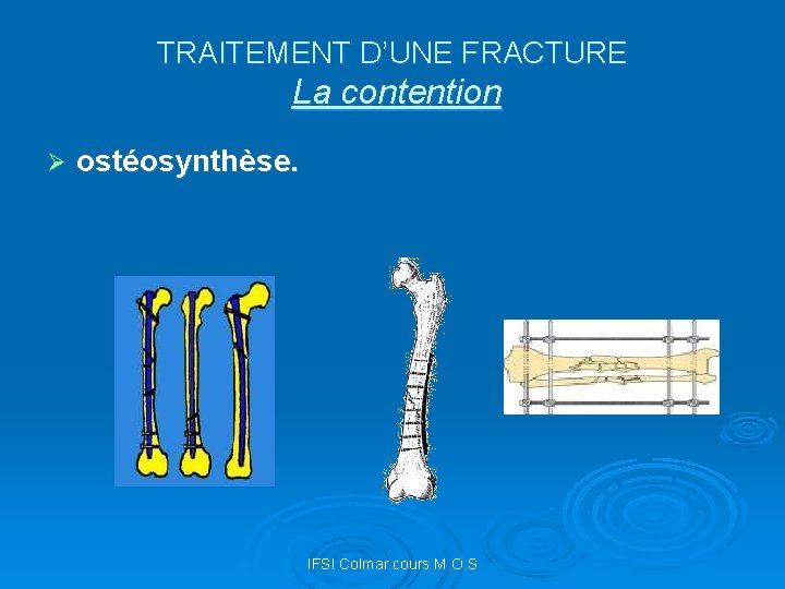 TRAITEMENT D’UNE FRACTURE La contention Ø ostéosynthèse. IFSI Colmar. cours. M. O. S 