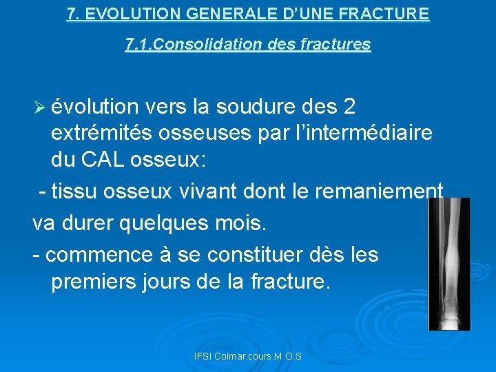 7. EVOLUTION GENERALE D’UNE FRACTURE 7. 1. Consolidation des fractures Ø évolution vers la