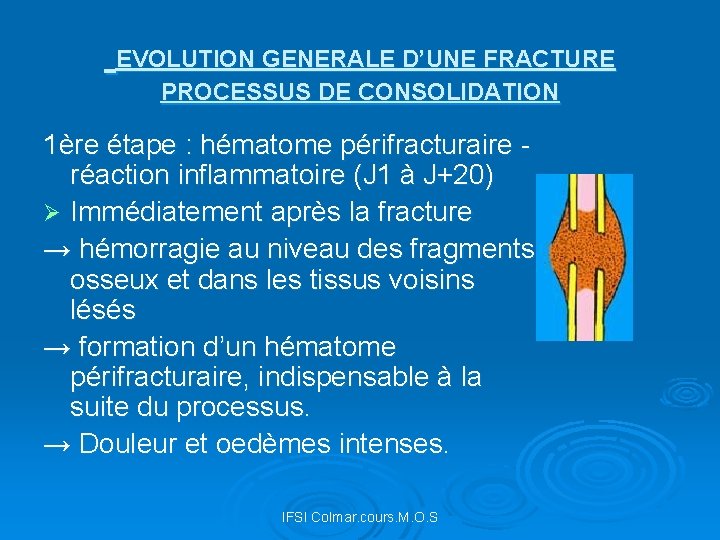  EVOLUTION GENERALE D’UNE FRACTURE PROCESSUS DE CONSOLIDATION 1ère étape : hématome périfracturaire -