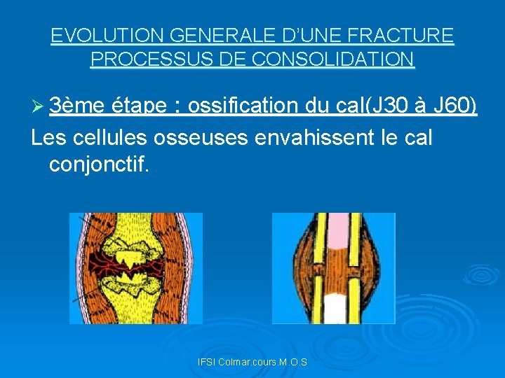 EVOLUTION GENERALE D’UNE FRACTURE PROCESSUS DE CONSOLIDATION Ø 3ème étape : ossification du cal(J