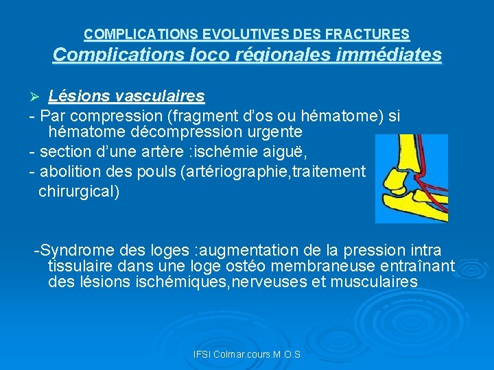 COMPLICATIONS EVOLUTIVES DES FRACTURES Complications loco régionales immédiates Lésions vasculaires - Par compression (fragment
