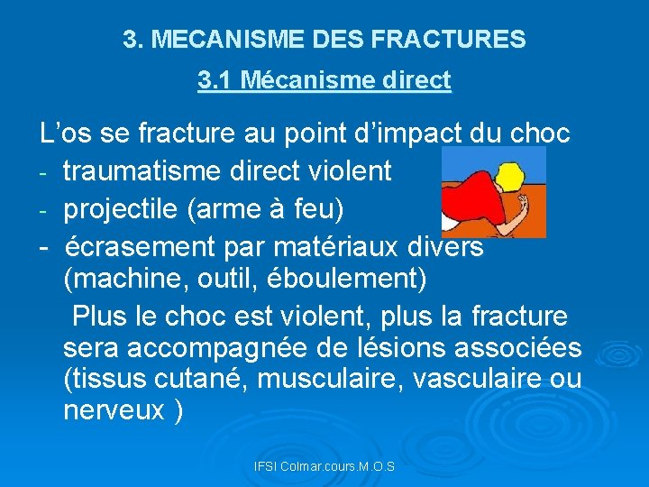 3. MECANISME DES FRACTURES 3. 1 Mécanisme direct L’os se fracture au point d’impact