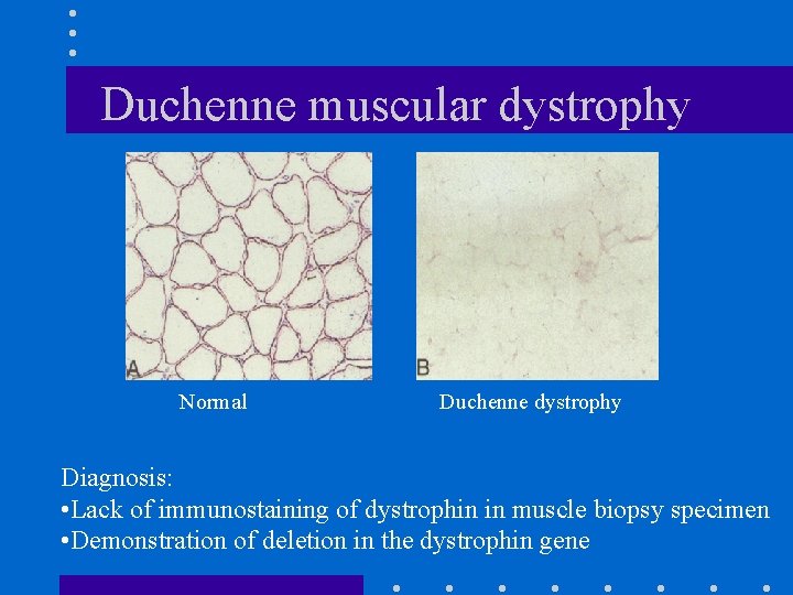 Duchenne muscular dystrophy Normal Duchenne dystrophy Diagnosis: • Lack of immunostaining of dystrophin in